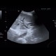 Biliary stent, obstruction: US - Ultrasound